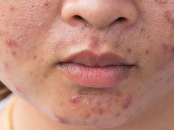 acne spots