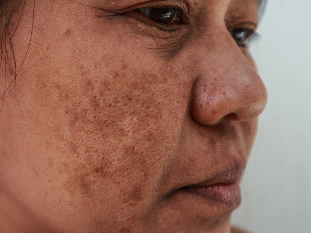 hyperpigmentation melasma