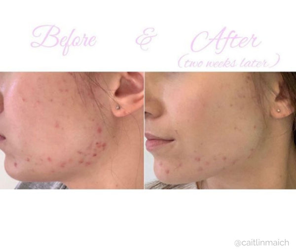 Before and After Skincare Results using Living Nature