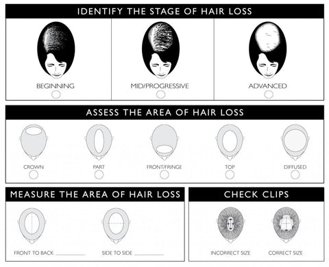 Stages of Hair Loss