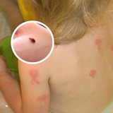 bed bug bites on kids