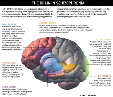 cbd-22q112ds-digeorge-syndrome-schizophrenia-brain