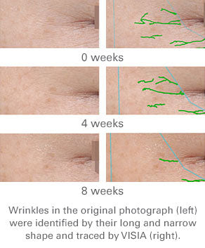 Change in number of wrinkles scanned by VISIA over an 8 week period