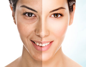 Skin aging 