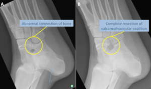 Abnormanl connection bone