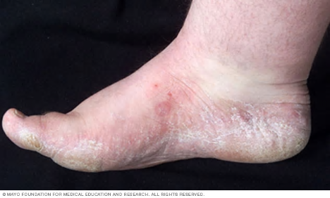 Foot affected by athlete's foot