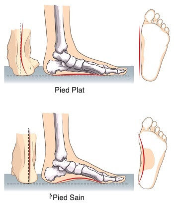 platypodie-deformation-pied