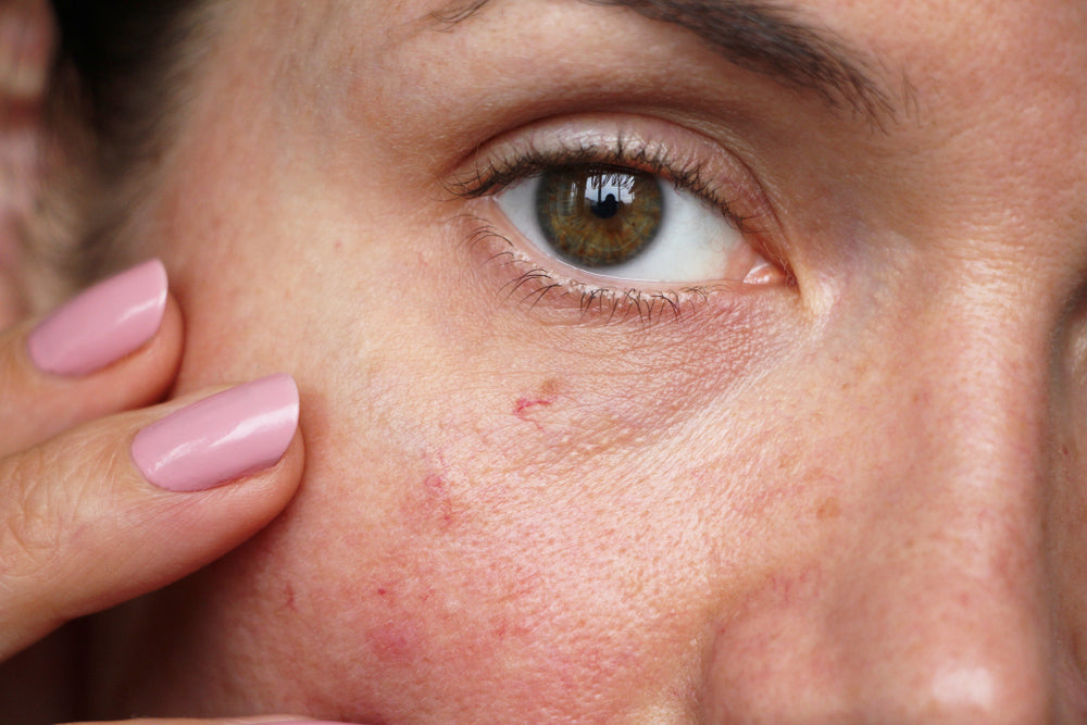 Face 11 Ways to Get Rid Red Spots on Face | Colorescience
