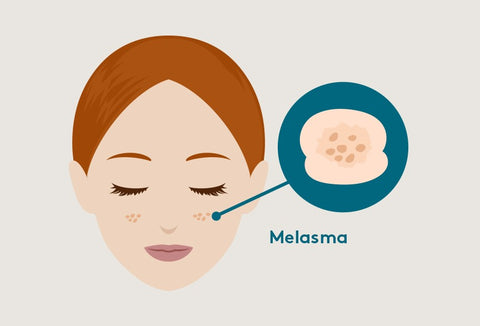 Melasma on face