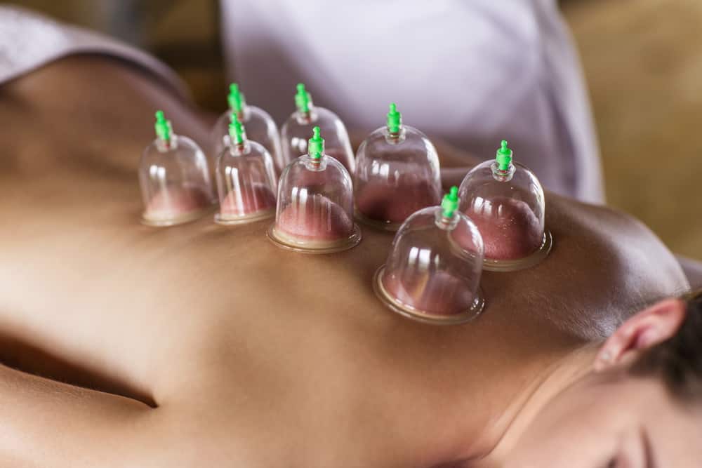 Woman with cupping treatment on back