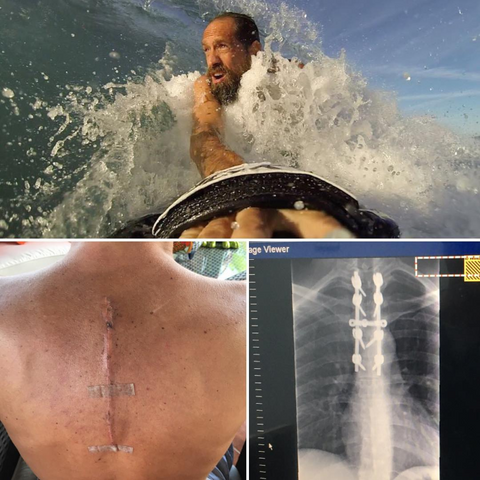Surf Injury Recovered with Slyde Handboards