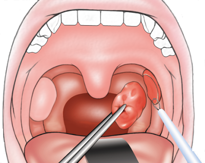 Tonsillectomy-Adenoidectomy-2-Seattle