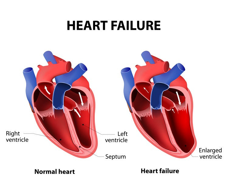 Heart Failure Diagram