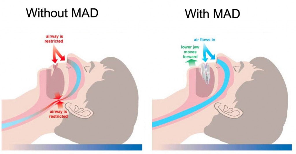 How MAD Works