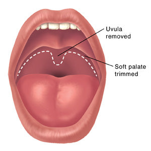 Uvulopalatopharyngoplasty (UPPP)