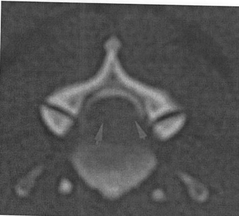 Left-ventral extradural compression at C2-3