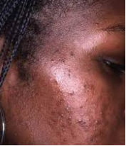 Taches brunes suite à de l'acné sur la joue d'une femme noire