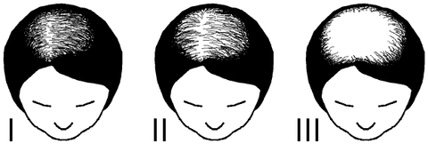 Female pattern baldness