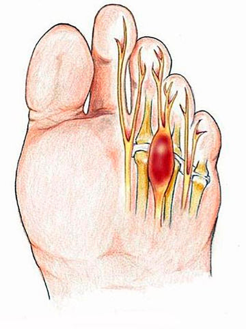 Neuroma de Morton - Saiba um pouco mais sobre um dos problemas mais comuns nos pés das mulheres e dos atletas. Imagem: Freepik