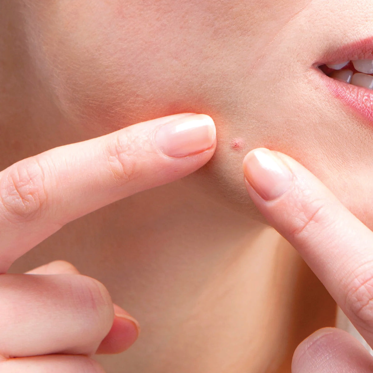 hyppigt gennembore nederdel How to Properly Pop a Pimple | Luminosityskin