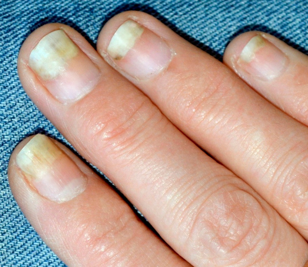 fingernail problems from gloves in COVID pandemic onycholysis