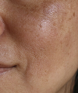 fight summer skin hyperpigmentation and uneven skin pigment