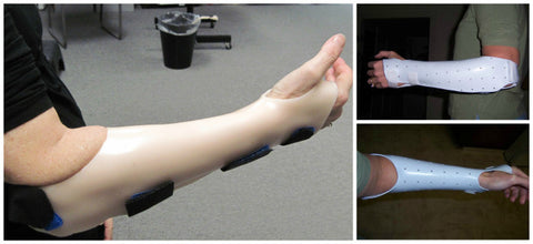Examples of a Muenster Orthosis.