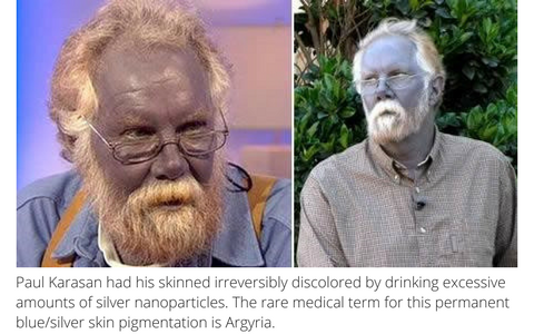 Paul Karasan had his skinned irreversibly discolored by drinking excessive amounts of silver nanoparticles. The rare medical term for this permanent blue/silver skin pigmentation is Argyria.