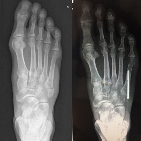 X-Ray of before and after surgery