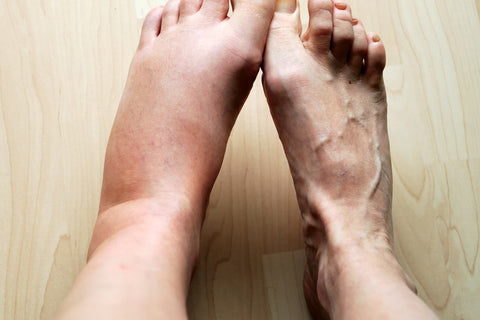 What are the symptoms of poor blood circulation