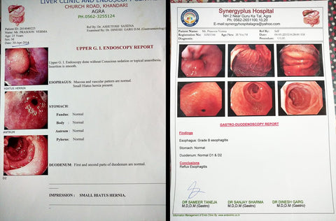 prasoon verma reports hiatal hernia before and after
