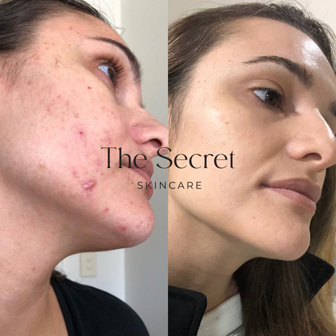Acne Before and After #3