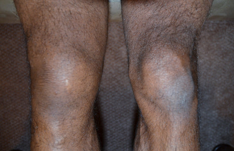 Note the swelling of the right knee compared to the left. Photo taken on Thursday.