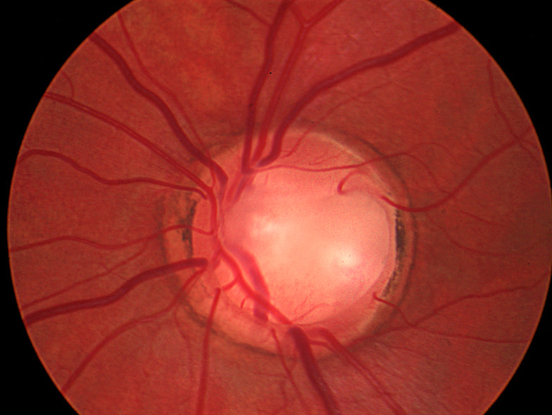 glaucomatous optic nerve appearance