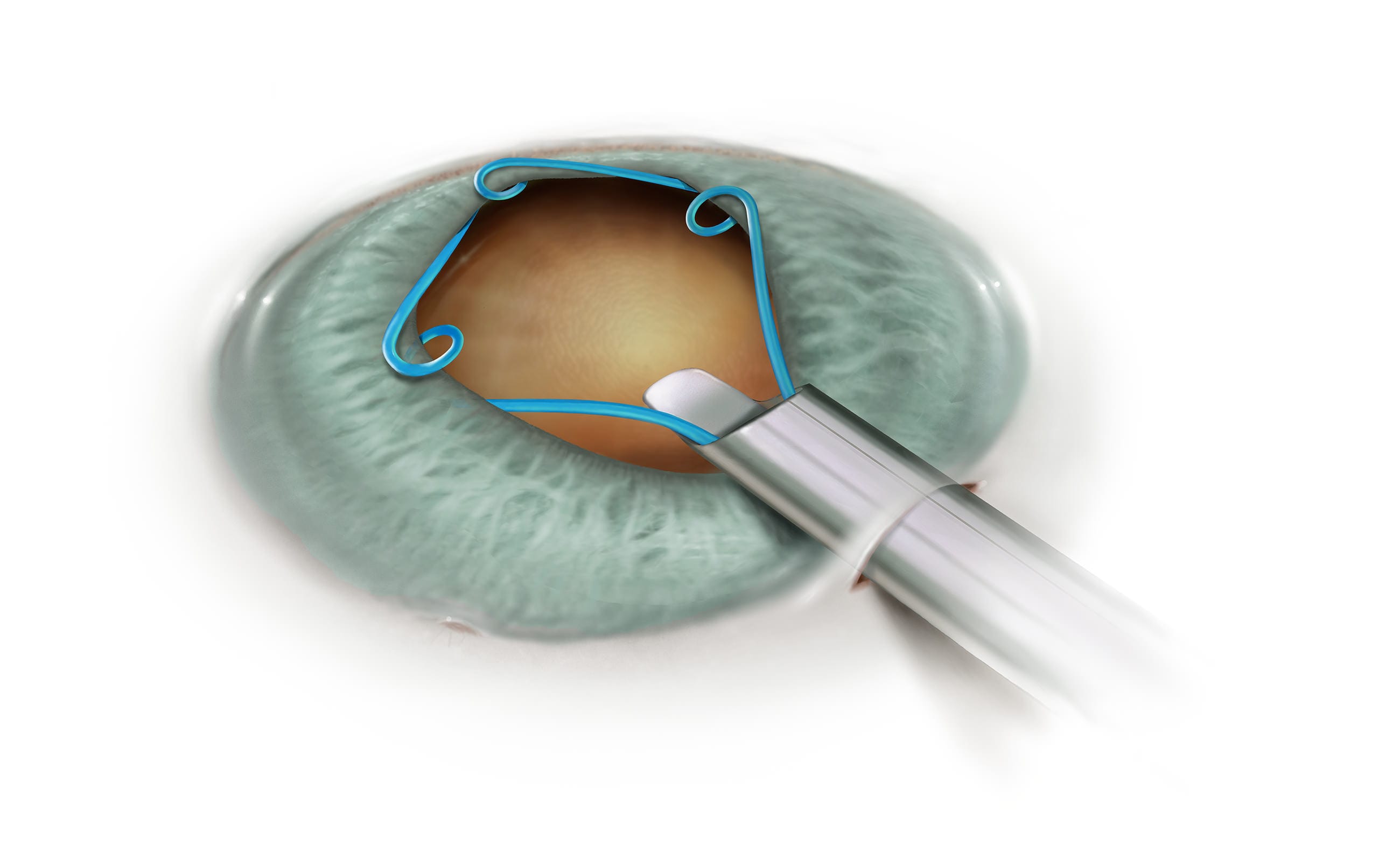 Insertion of Malyugin Ring during cataract surgery