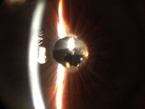 intraocular lens implant in pseudoexfoliation syndrome