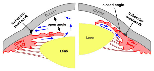 open versus narrow angle glaucoma image