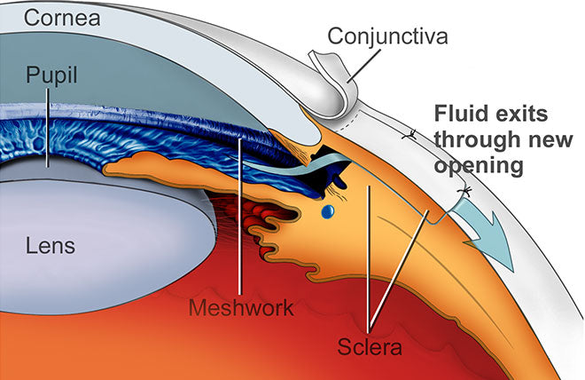 trabeculectomy surgery for glaucoma