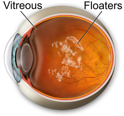 vitreous floaters eye floaters diagram image