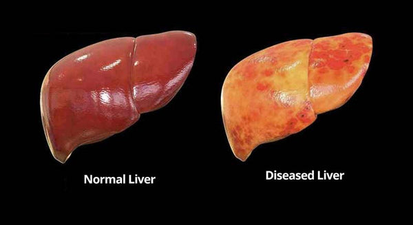 Hepatic Steatosis Treatment