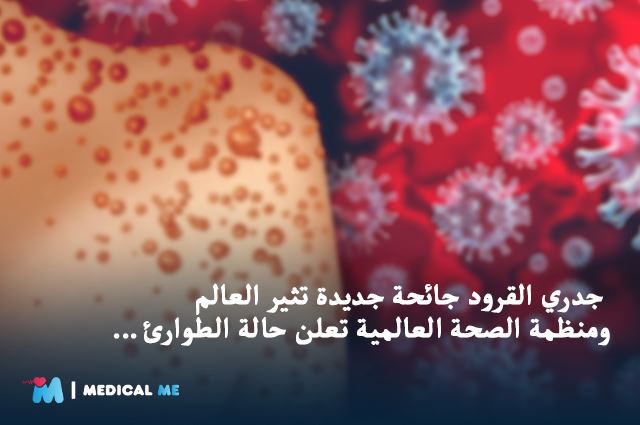 Monkeypox Virus symptoms, transmission, treatment