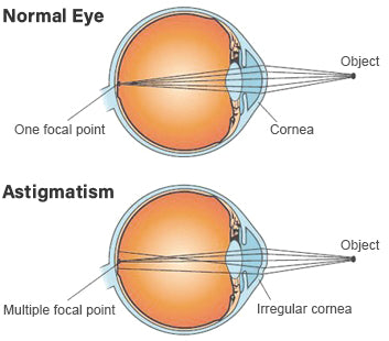 Definition of astigmatism