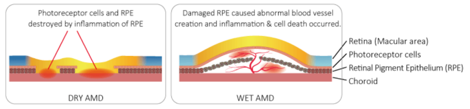 Age-related macular degeneration (AMD)