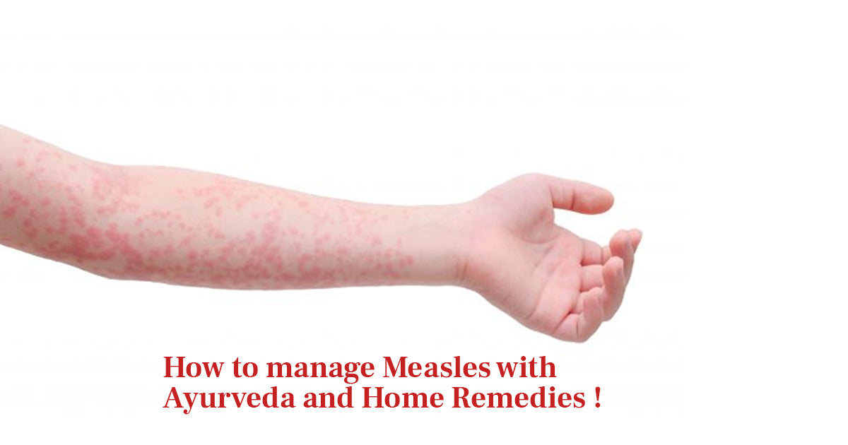 How to Manage Measles with Ayurveda and Home Remedies!