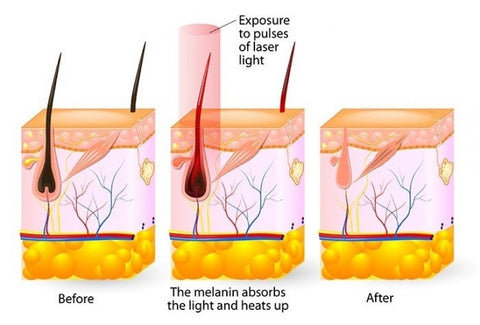 Sheer Elegance hair removal IPL epilator stages follicles