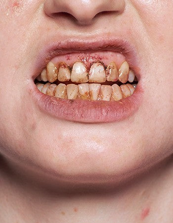 golden zombie teeth