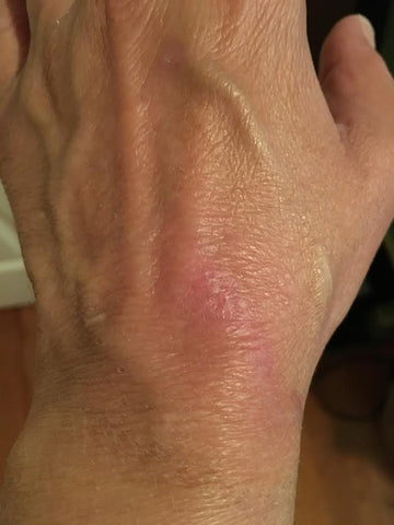 Burned Hand after primocyn