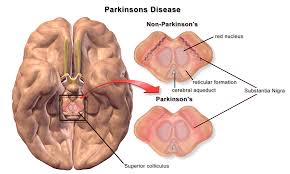 Parkinson Dance