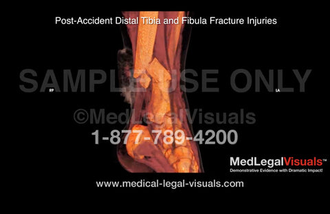 Medical Legal Animation of 3D CT Scans for Injury Cases