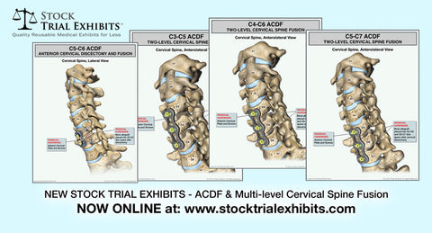 ACDF and Cervical Fusion Medical Exhibits for Injury Attorneys